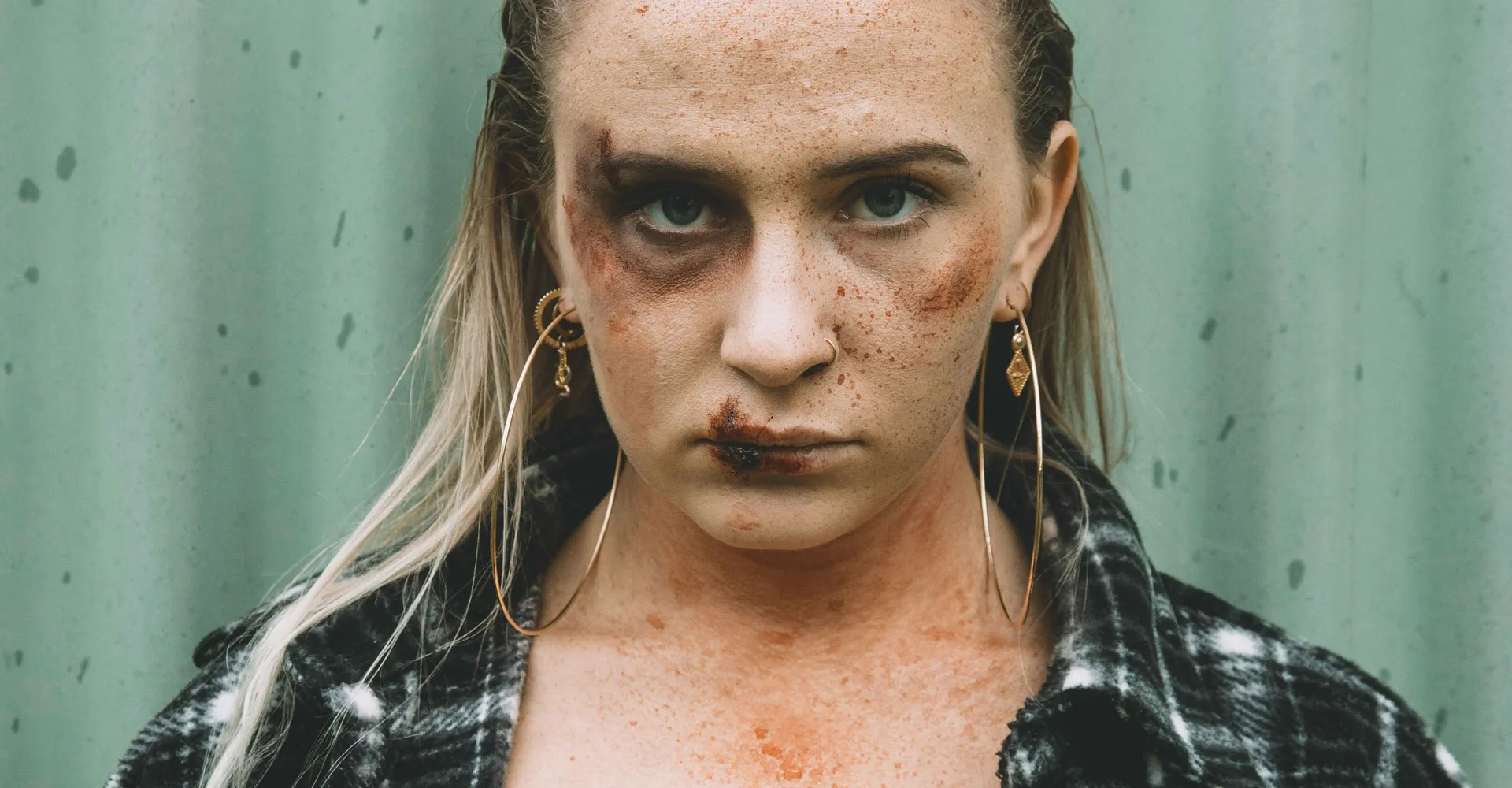 Assault in Shared Accommodation Leading to Multiple Facial Fractures winston-solicitors-abuse-assault-cica-assault-in-shared-accommodation
